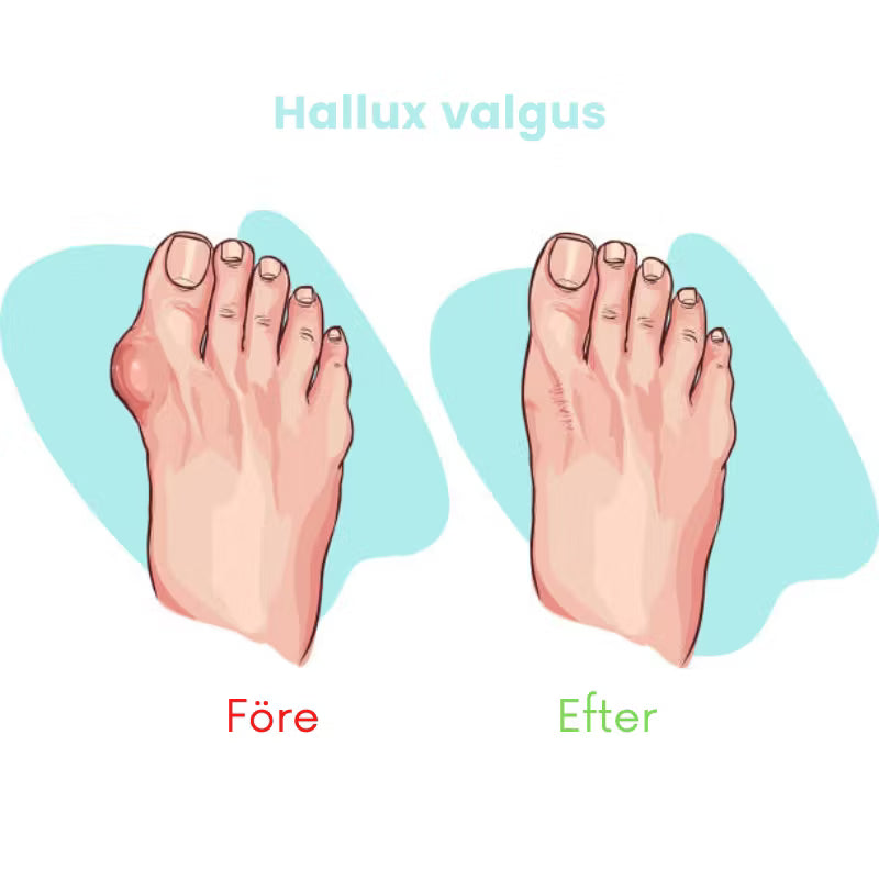 Tåspridare för Hammartå och Hallux valgus (2st)