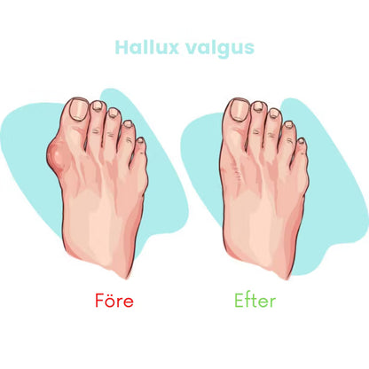 Tåspridare för Hammartå och Hallux valgus (2st)