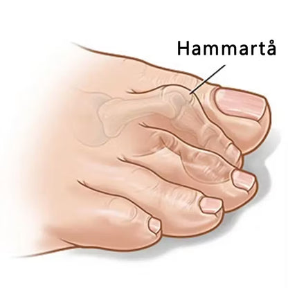 Hammartå förfot (2st)